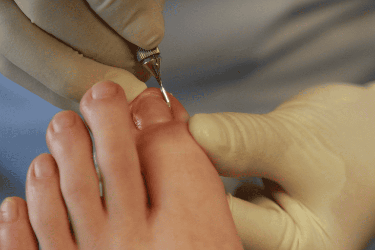 Gloved hands using needle on toenail