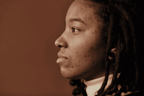 Face of individual with acne discoloration