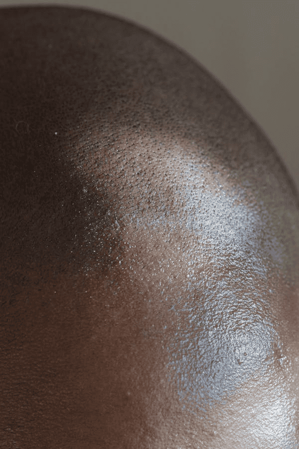 Close-up of scalp