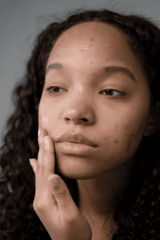 Face of individual with acne discoloration