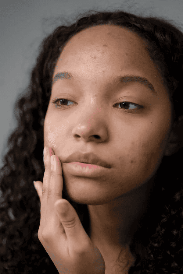 Face of individual with acne discoloration