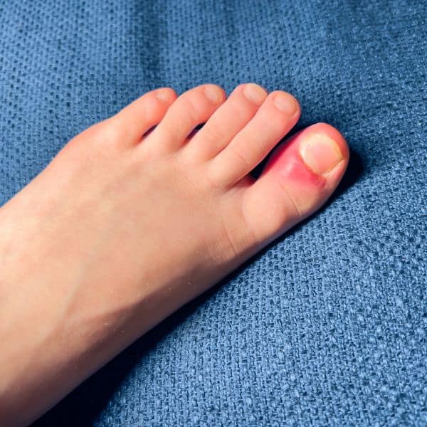 Swollen toenail due to ingrown