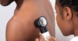 Skin cancer in blacks as depicted by black dermatologist using dermatoscope on black patient's back